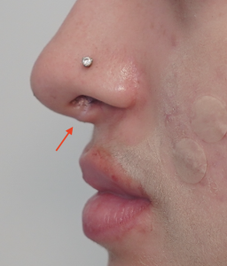 scarless rhinoplasty by Dr. Vladimir Grigoryants