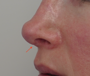 Notched scar after open rhinoplasty