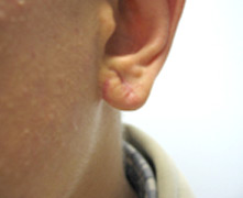earlobe surgery Los Angeles