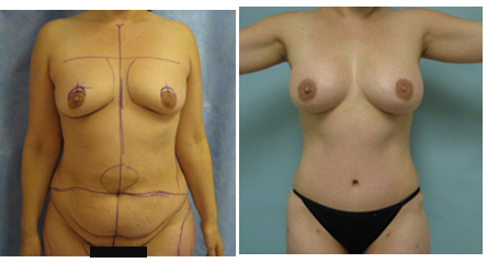 Tummy tuck and breast augmentation
