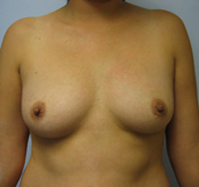 breast augmentation beverly hills