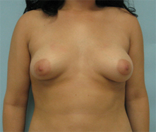 breast implants thousand oaks