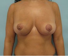 breast lift in los angeles