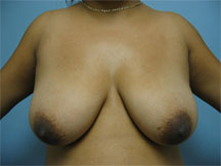 breast lift burbank encino