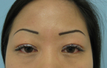 Los angeles double eyelid surgery
