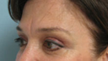 eyelid surgery los angeles