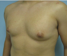 male breast surgery los angeles