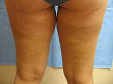 liposuction thighs