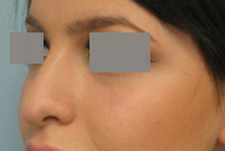 rhinoplasty oblique view before