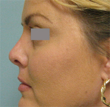 Los Angeles revision nose surgery