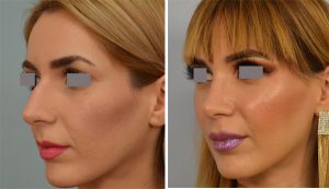 Vladimir Grigoryants rhinoplasty