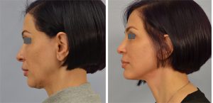 face and neck lift los angeles