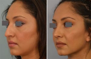 Rhinoplasty Grigoryants
