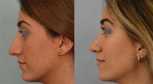 Los Angeles rhinoplasty