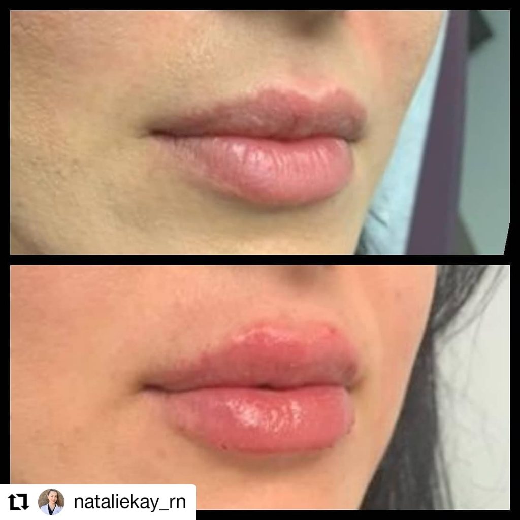 Lip Fillers Los Angeles Russian Lip Technique Best Injections Options