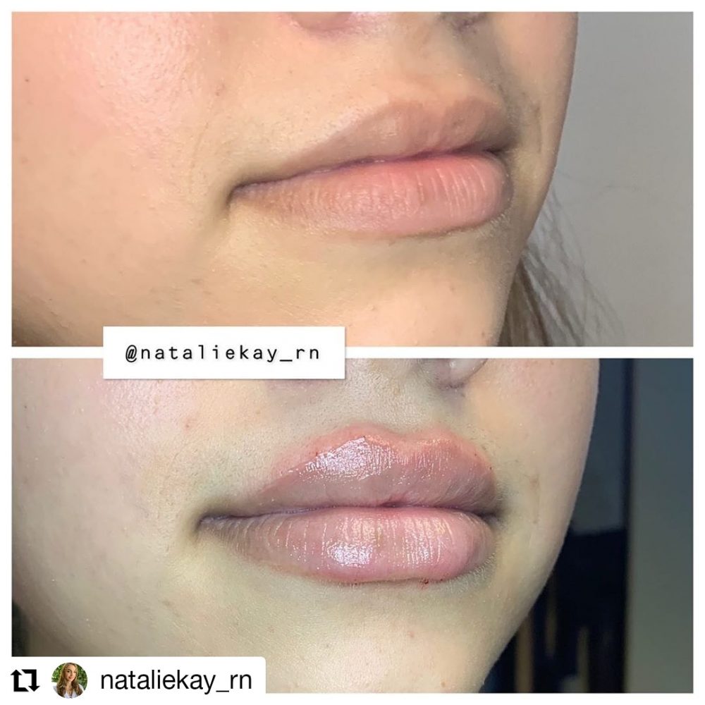Lip Fillers Los Angeles Russian Lip Technique Best Injections Options