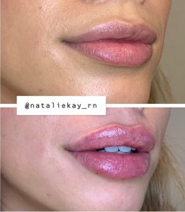 lip injections in Los Angeles