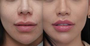 Lip lift Los Angeles