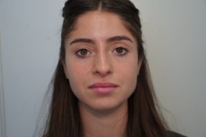 Closed rhinoplasty revision Grigoryants