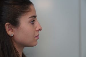Nose job revision before
